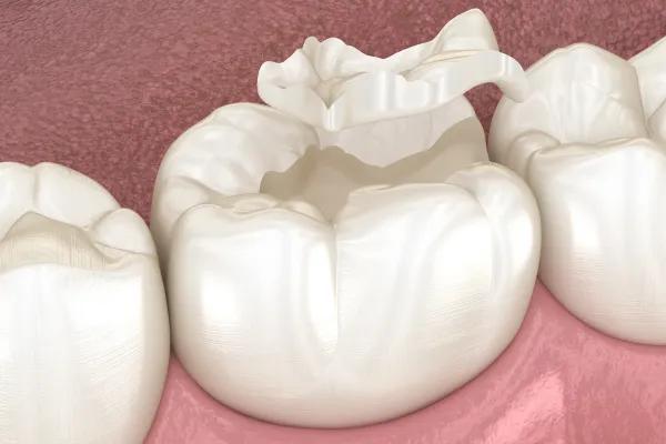 つめ物・かぶせ物のイメージ